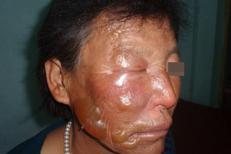 脸浅Ⅱ度烧伤图