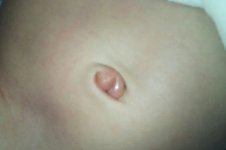 宝宝脐炎肚脐眼红肿图 宝宝脐炎肚脐眼红肿图