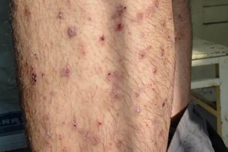 结痂性疥疮大腿症状图