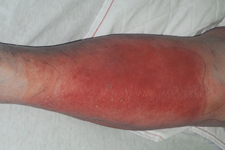 蜂窝织炎小腿发红图 蜂窝织炎小腿发红图