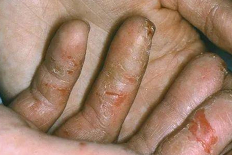 手部湿疹手指上有伤口流水图