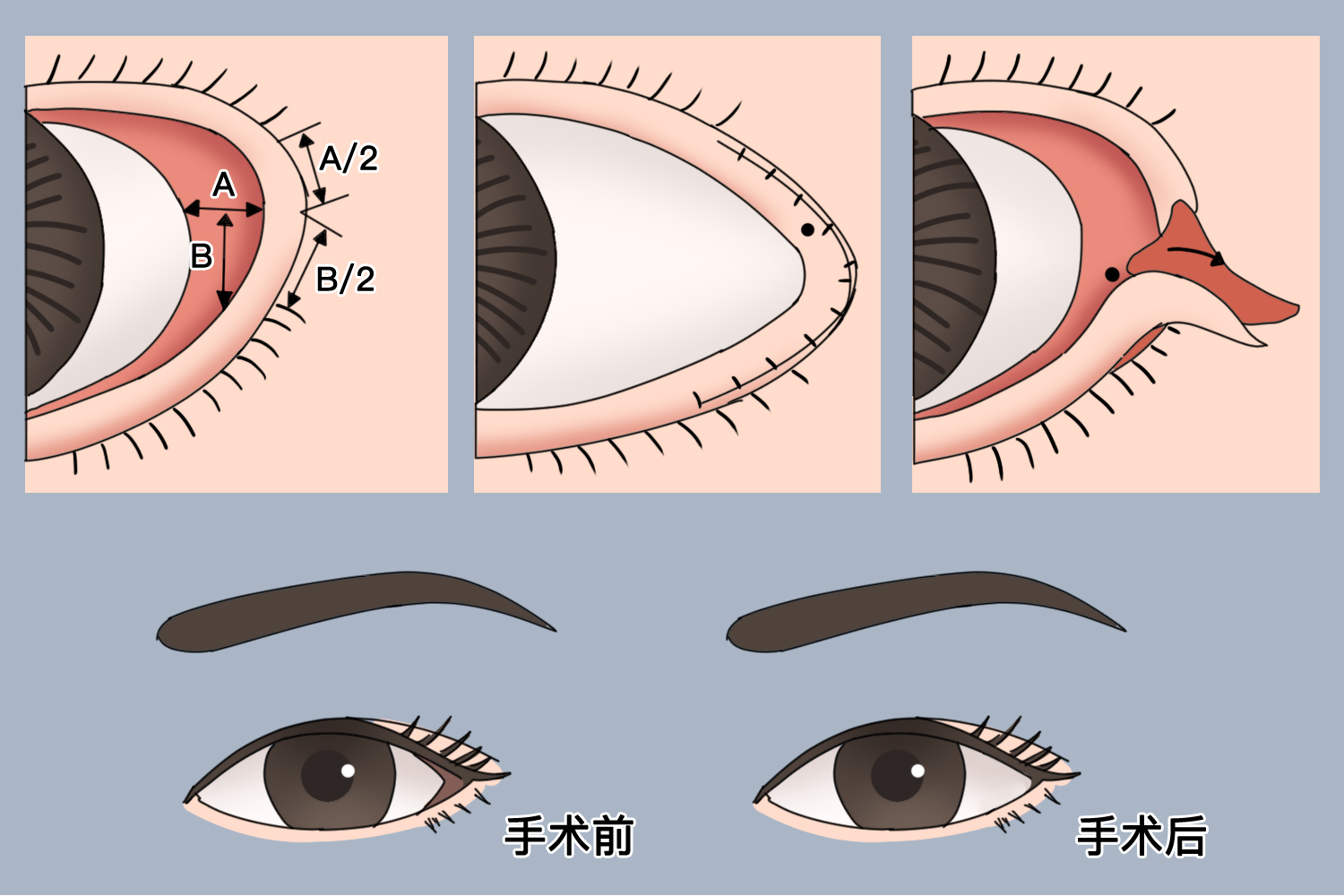 外眦开大术过程及效果图 外眦开大术过程及效果图