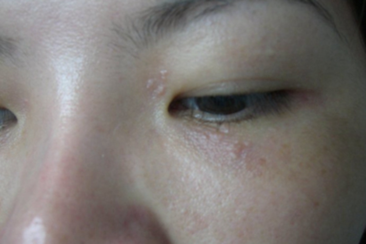 汗腺瘤眼周皮肤泛红有丘疹图 汗腺瘤眼周皮肤泛红有丘疹图