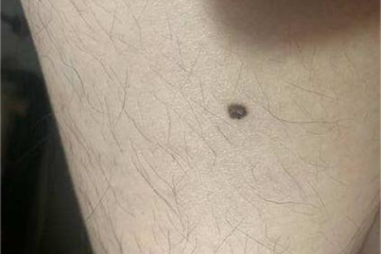 发育不良痣腿部黑痣图 发育不良痣腿部黑痣图