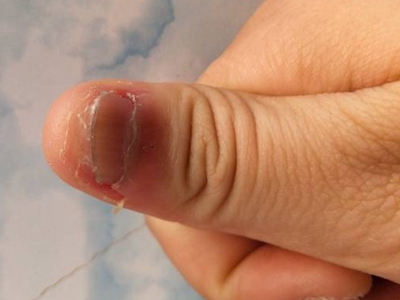 慢性甲沟炎手指甲周围红肿掉皮图.jpg