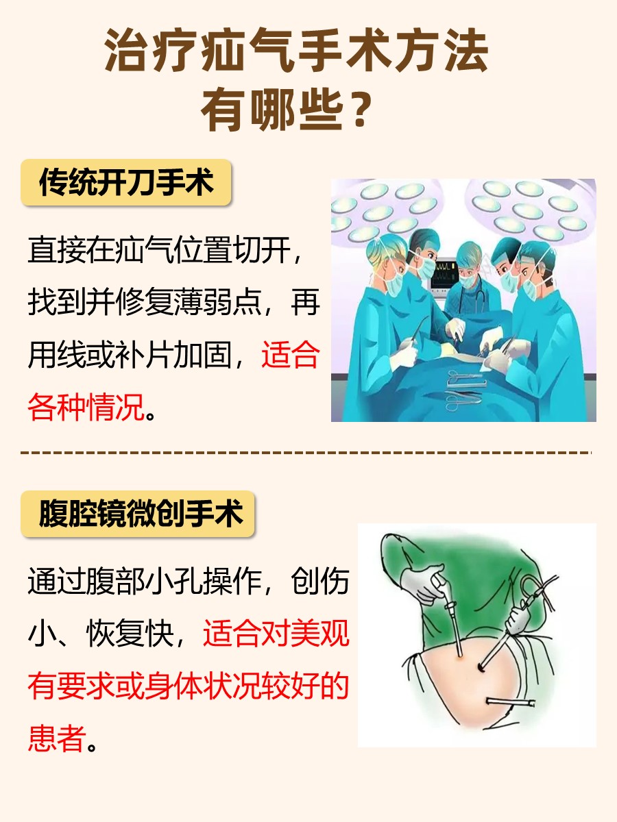 疝气手术大盘点：多种术式任你选！