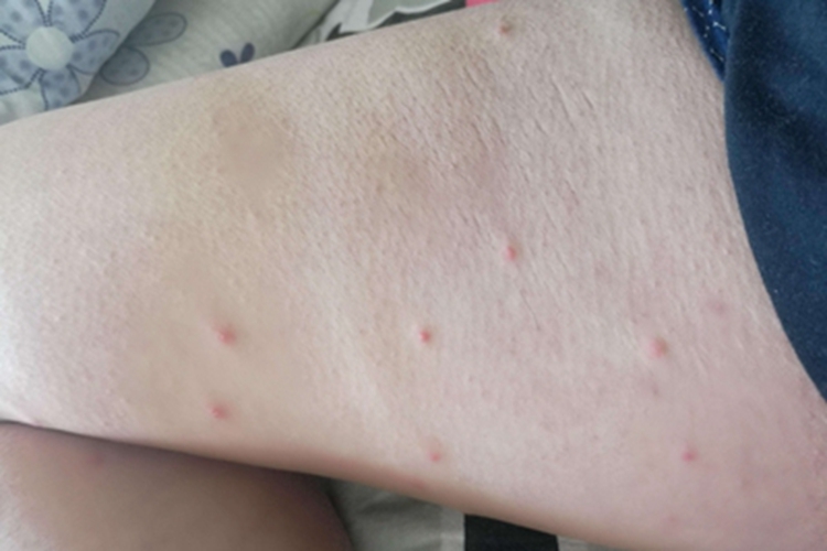 地方性斑疹伤寒大腿斑丘疹图