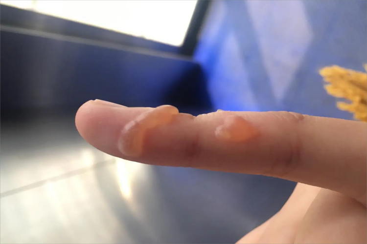 幼年型类天疱疮手指尖水疱图