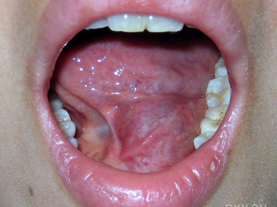 舌下腺囊肿舌下长一个大疙瘩图.jpeg