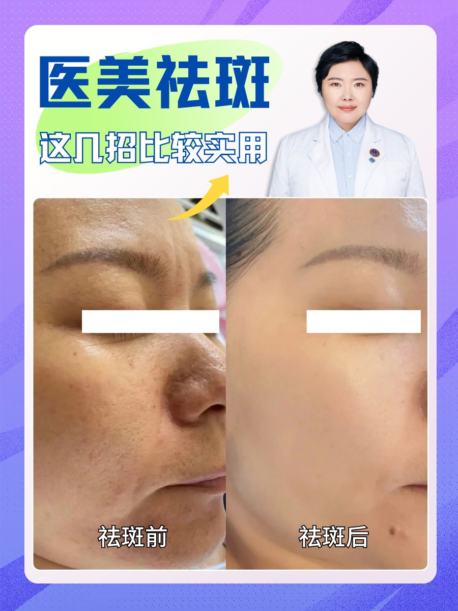 医美祛斑，这几招比较实用