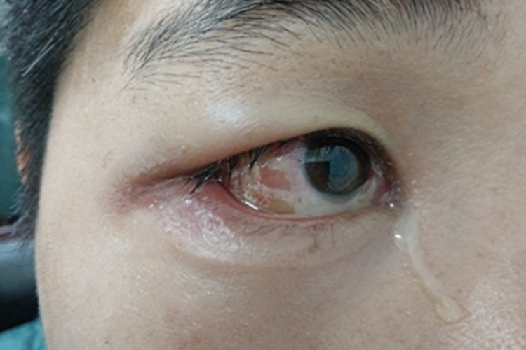 蜂窝织炎眼部肿图 蜂窝织炎眼部肿图