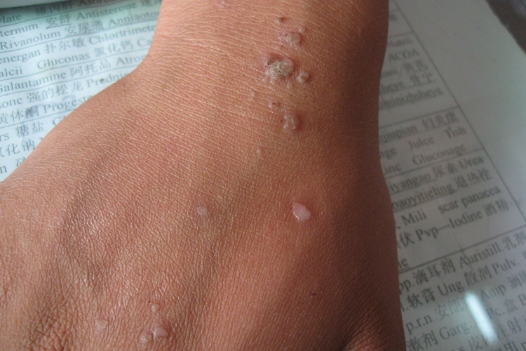 手上扁平疣图