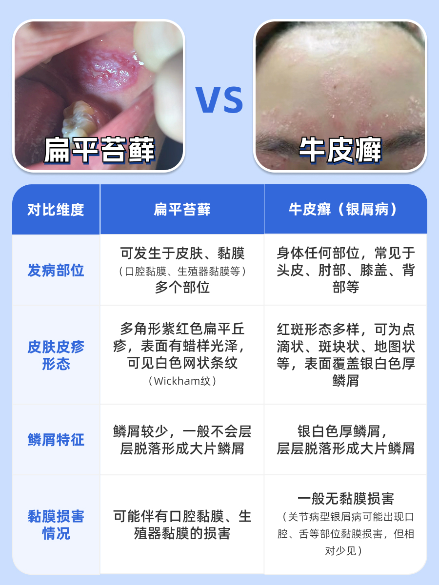 什么容易误诊成银屑病？皮肤科医生来揭秘