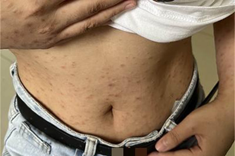 二期梅毒腹部暗红色丘疹图