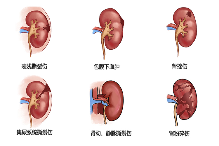 肾损伤图