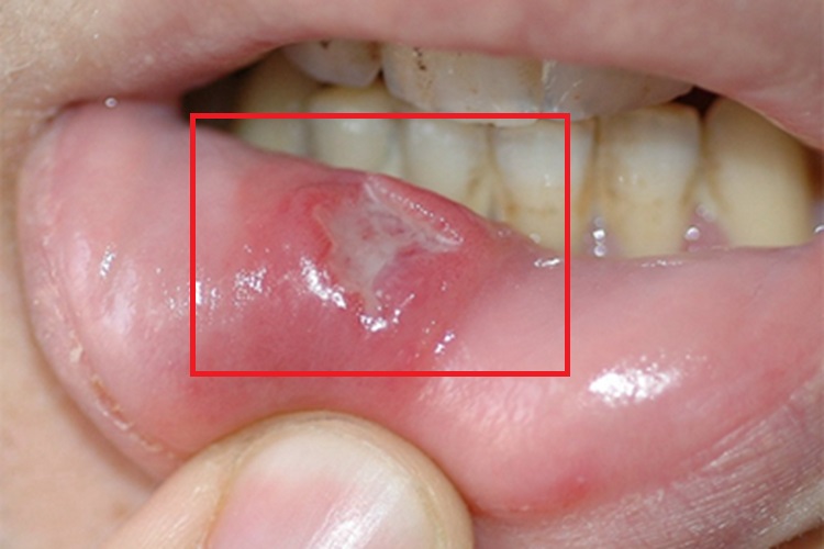 女性二期梅毒糜烂图 女性二期梅毒糜烂图