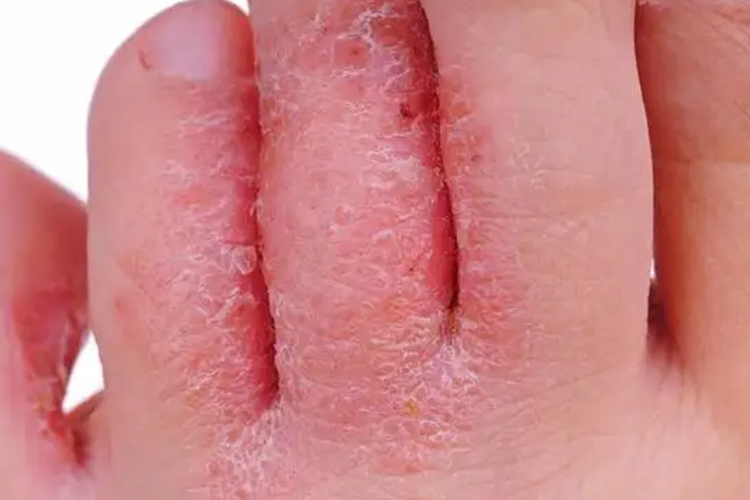 小儿浸渍糜烂型脚癣