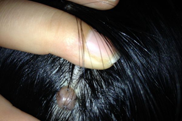 单发性有蒂软纤维瘤头皮肉球图 单发性有蒂软纤维瘤头皮肉球图