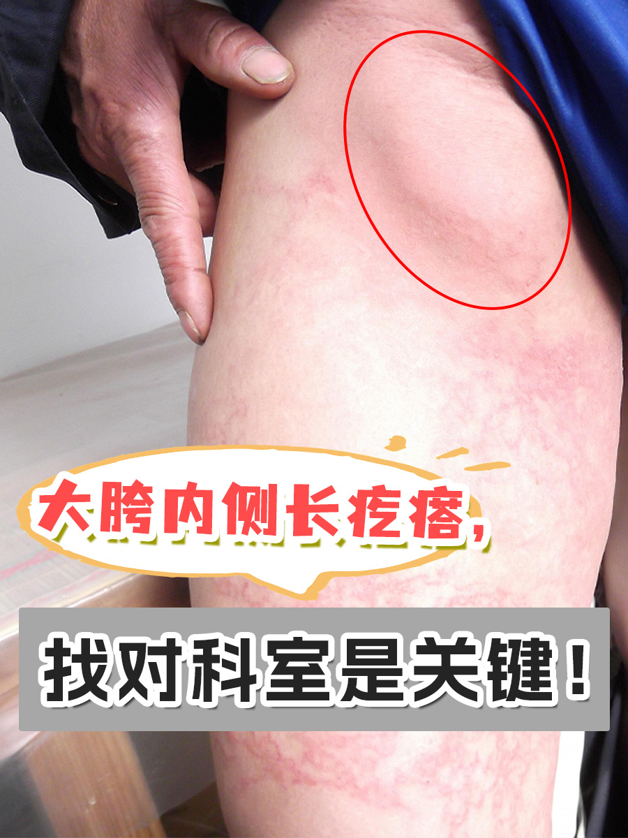 大胯内侧长疙瘩,找对科室是关键!