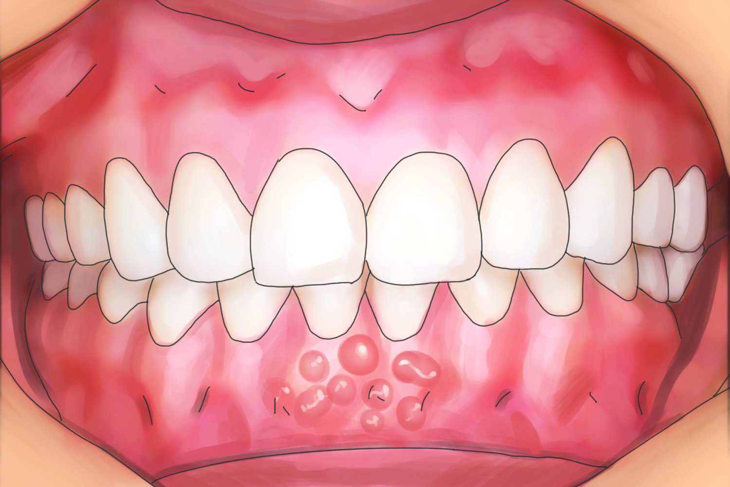 疱疹性龈口炎小水疱图