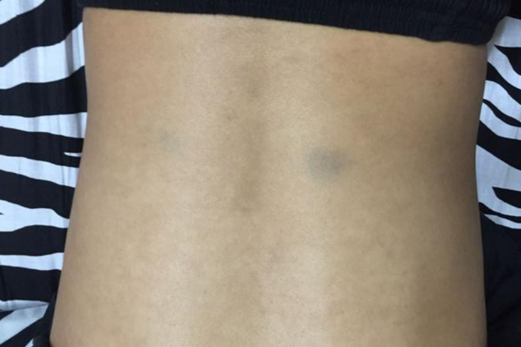 岔气导致的腰背部疼痛位置示意图