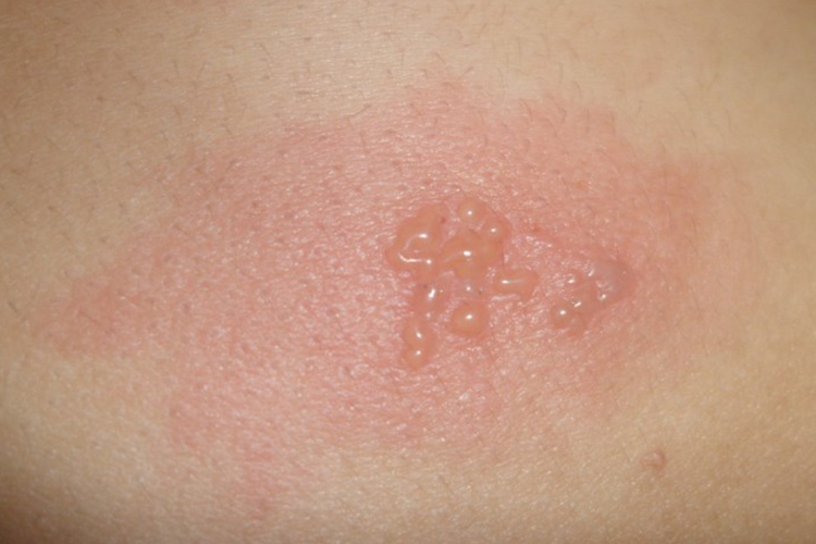 铁过敏水疱图 铁过敏水疱图