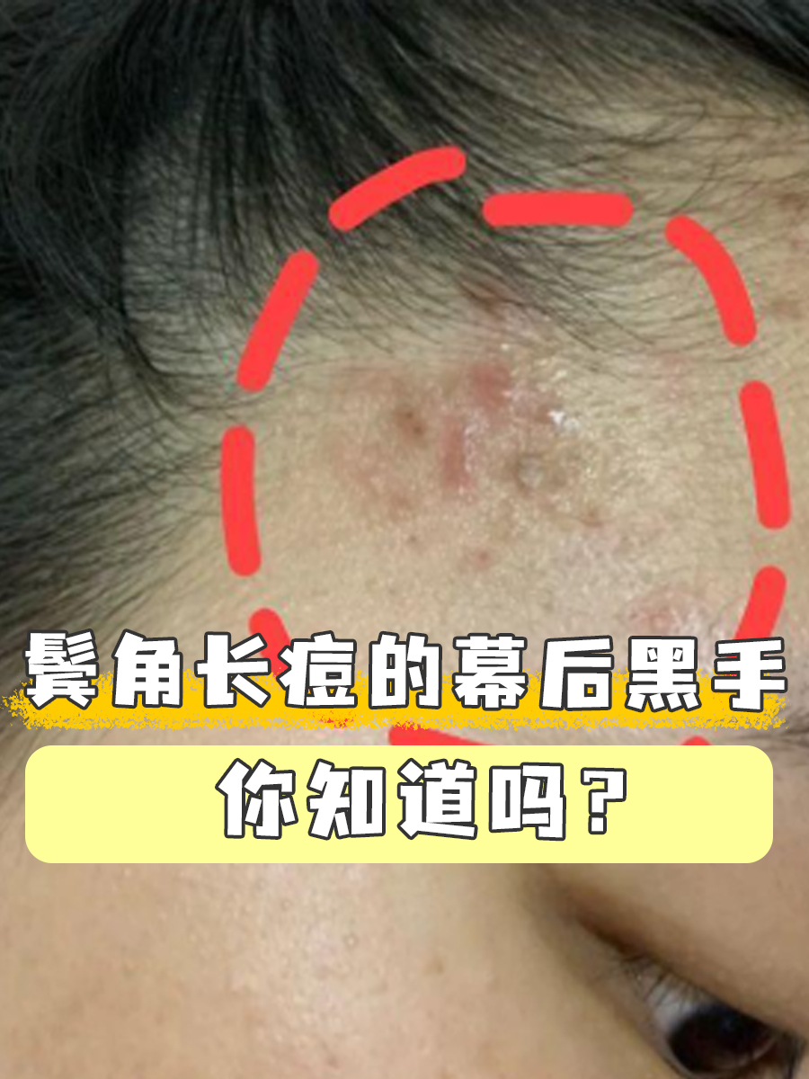 鬓角长痘的幕后黑手,你知道吗?