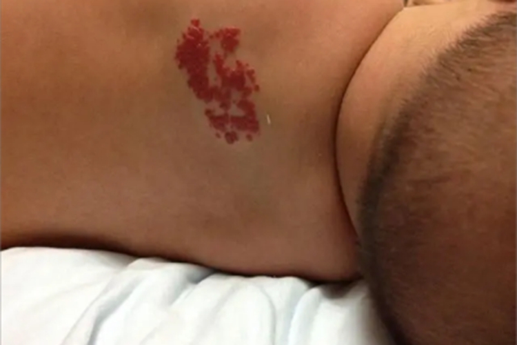 血管角化瘤背部充血图