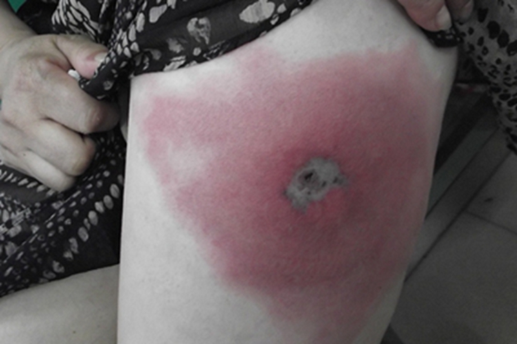 虫咬皮炎糜烂图 虫咬皮炎糜烂图