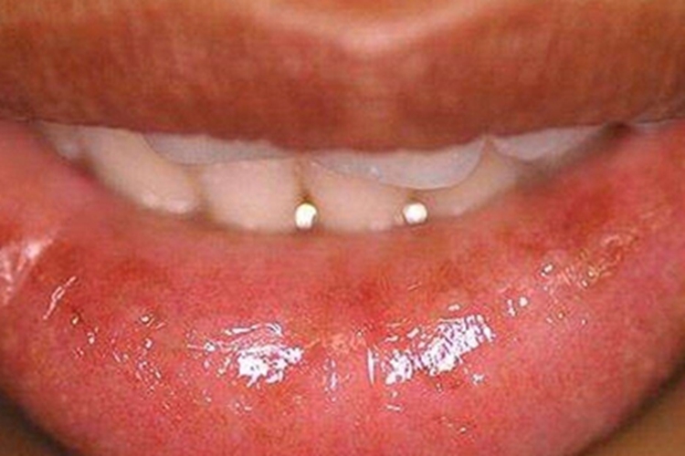 化脓性腺性唇炎嘴唇红肿图