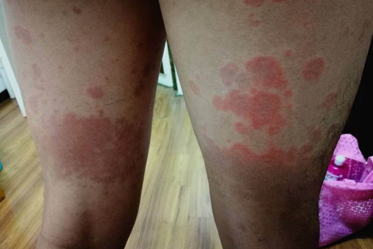 海水过敏皮肤症状图