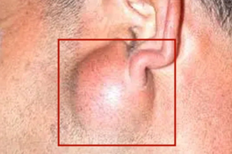 腮腺皮样囊肿耳周症状图 腮腺皮样囊肿耳周症状图