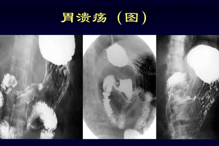 胃溃疡X线图