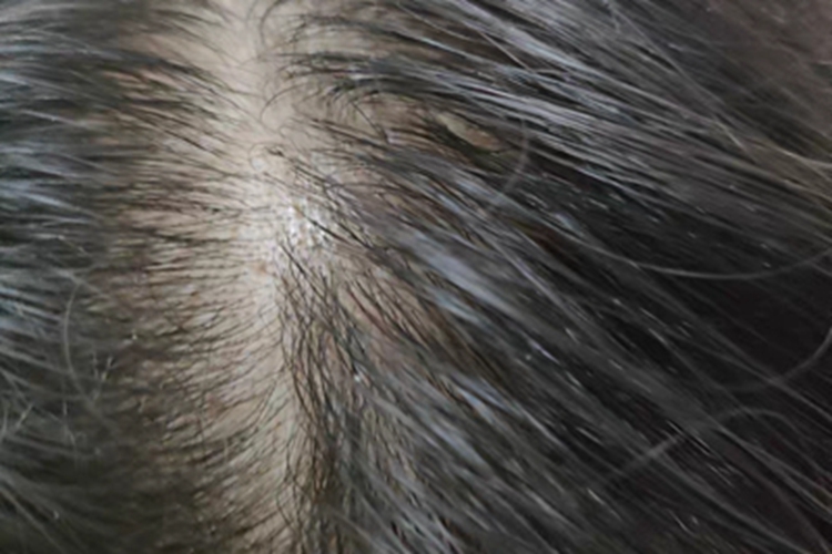 雄激素性脱发发缝明显增宽图