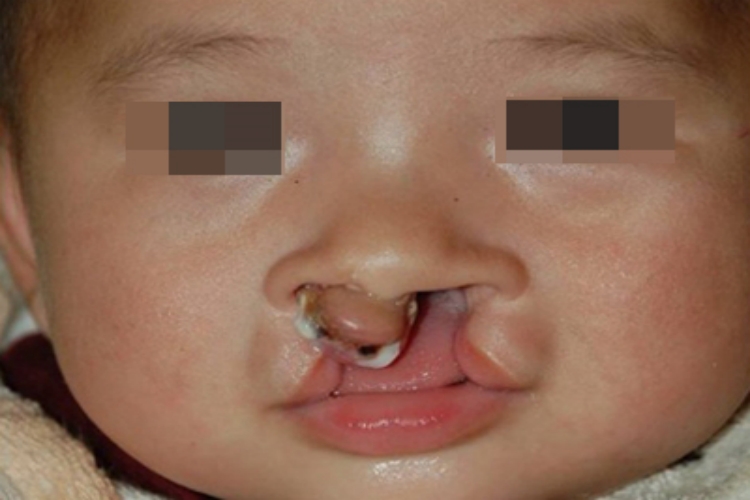 唇腭裂嘴唇裂口图 唇腭裂嘴唇裂口图