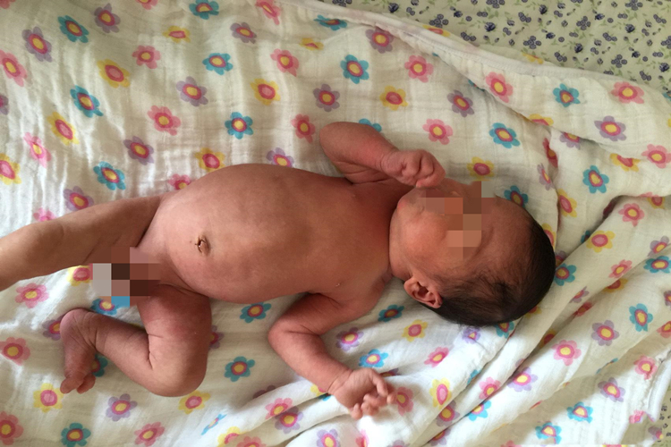 新生儿功能性消化不良腹部鼓鼓的图 新生儿功能性消化不良腹部鼓鼓的图