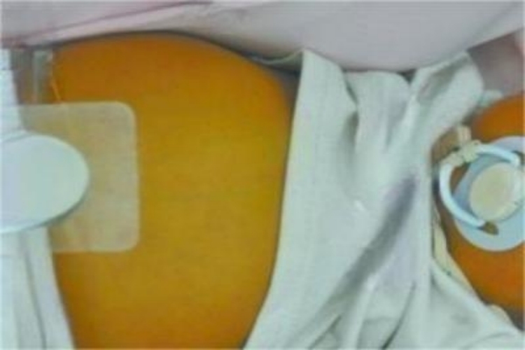 新生儿病理性黄疸腹部症状图