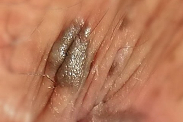 女性鲍恩样丘疹病黑斑图