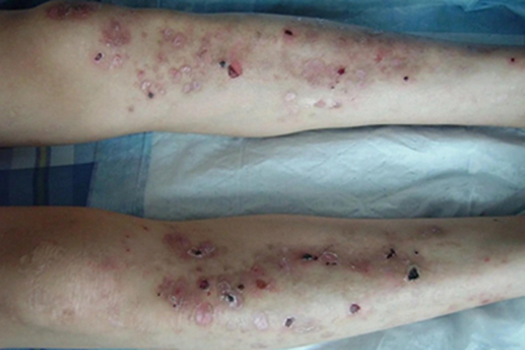 单纯型大疱性表皮松解症图