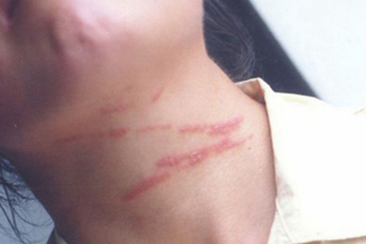 隐翅虫皮炎前颈红斑图