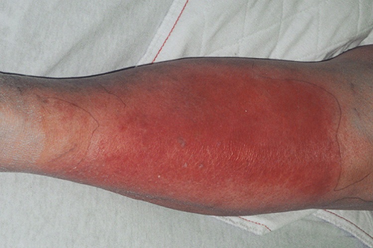 类丹毒小腿红斑图