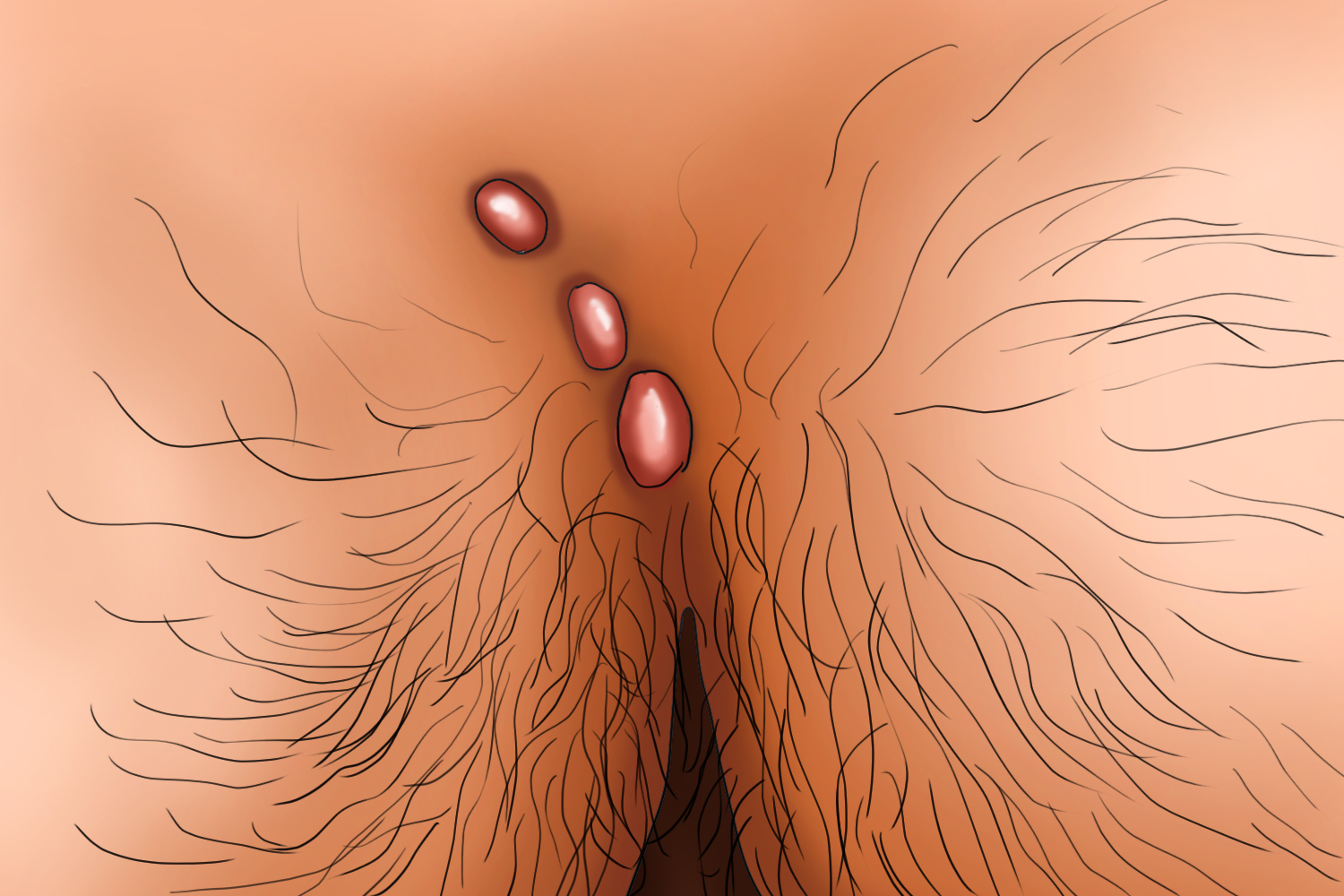 尾椎骨藏毛囊肿图 尾椎骨藏毛囊肿图