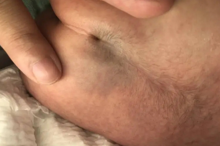 新生儿脊柱裂小凹图