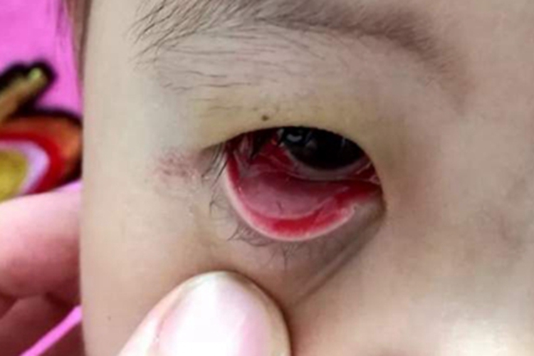 红眼病眼睑充血肿胀图