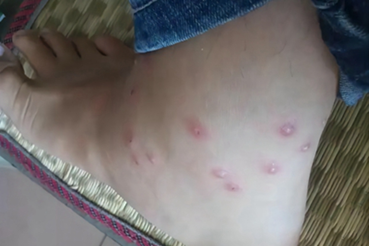 蚁蜇伤脚踝小红疙瘩图 蚁蜇伤脚踝小红疙瘩图