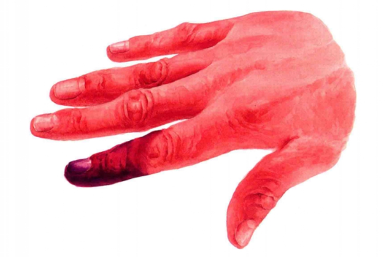 手指干性坏死图 手指干性坏死图