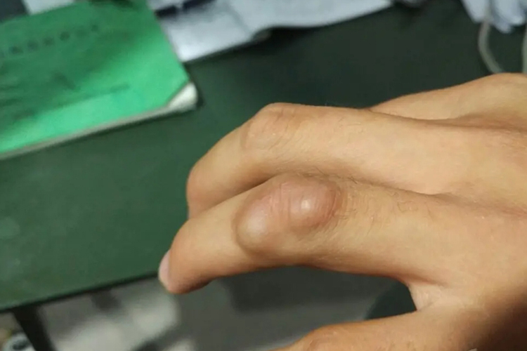 指关节腱鞘囊肿图