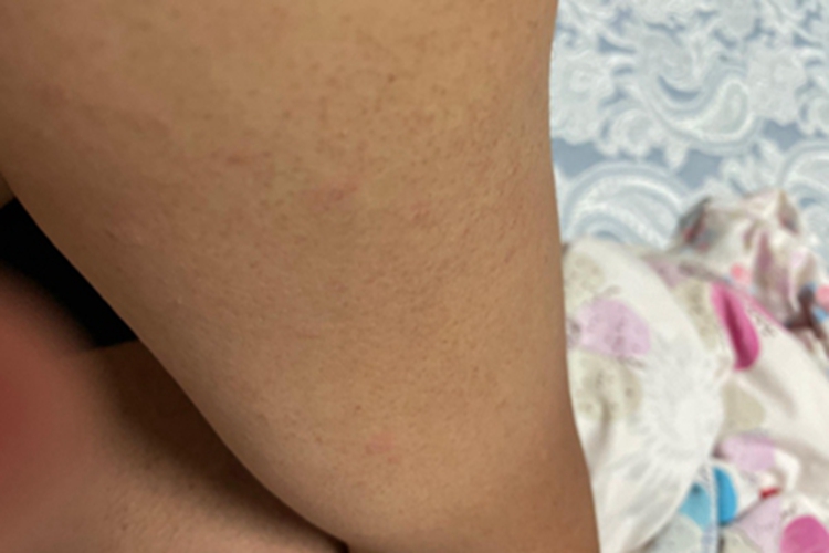 毛发角化病胳膊有丘疹图 毛发角化病胳膊有丘疹图