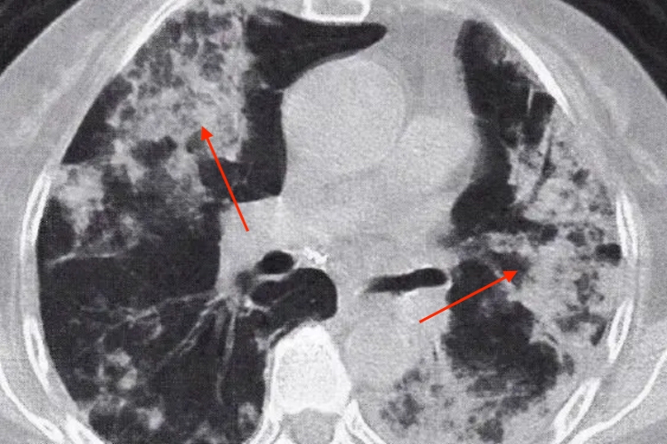 弥漫型肺癌CT图