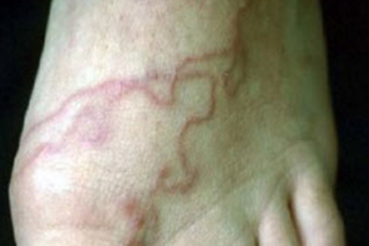 皮肤幼虫移行症脚背红斑图